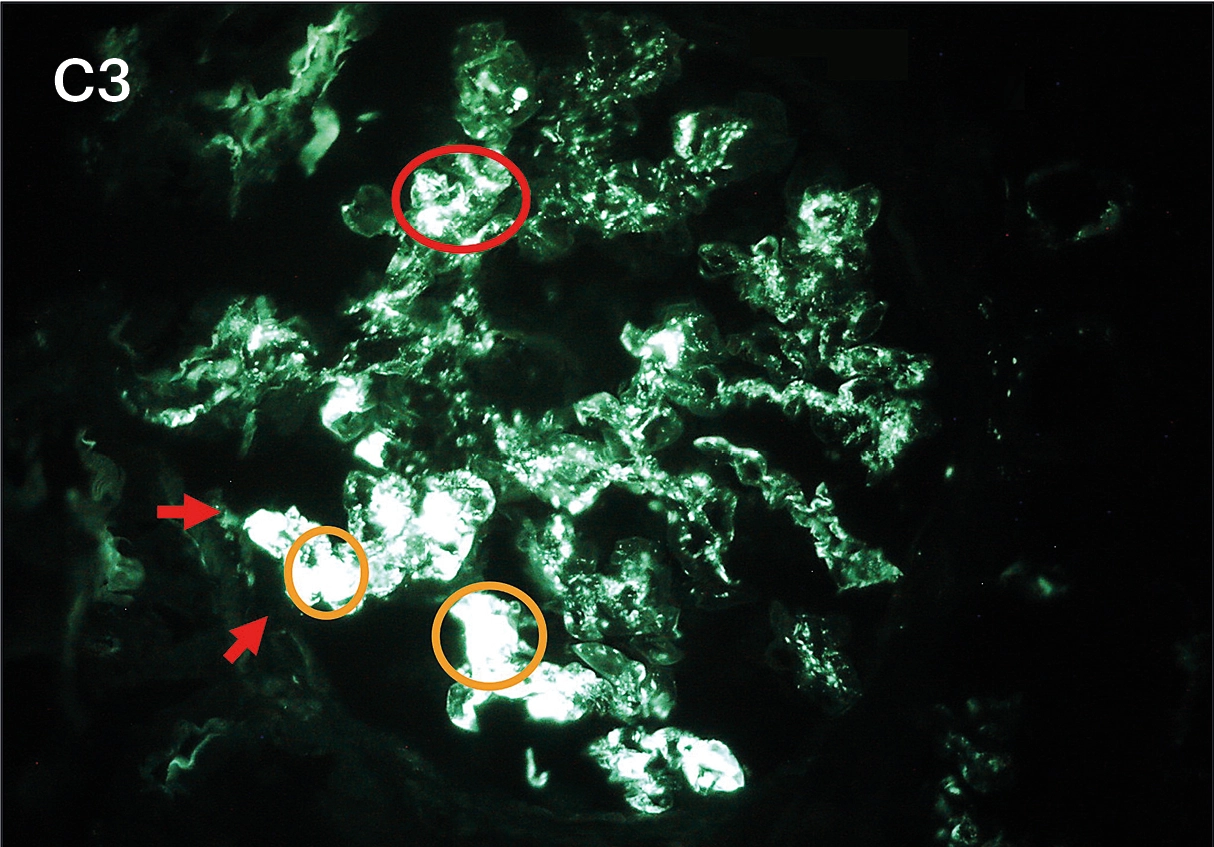 IFD para C3 e Ig con positividad intensa 3+ en patrón guirnalda en asas capilares, mesangios y pseudotrombos en vasculitis crioglobulinémica