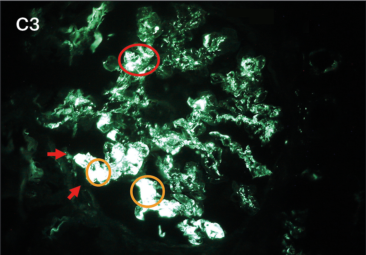 IFD para C3 e Ig con positividad intensa 3+ en patrón guirnalda en asas capilares, mesangios y pseudotrombos en vasculitis crioglobulinémica