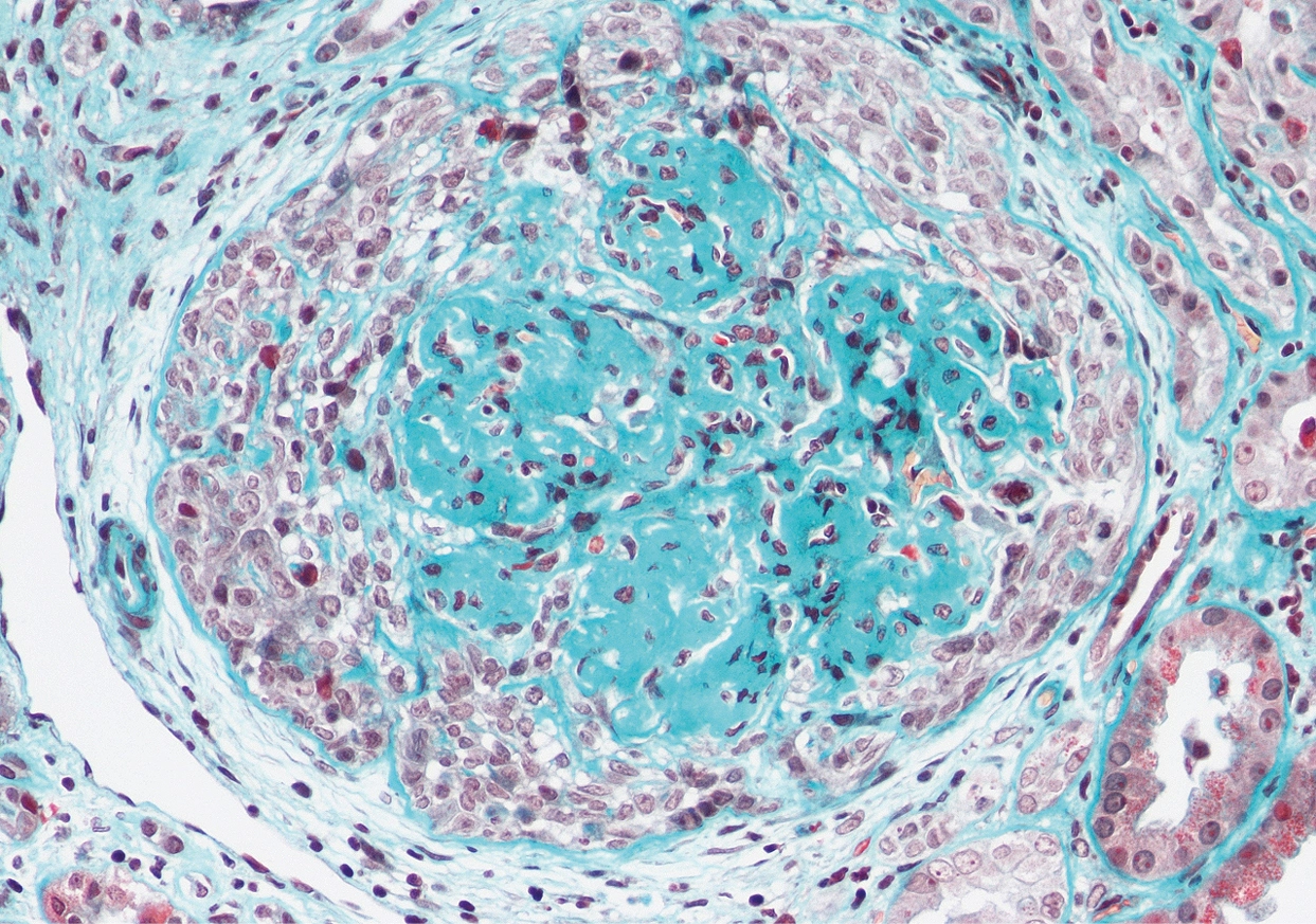 Tricrómico de Masson con semiluna en glomerulonefritis fibrilar, presente hasta en un 20% de los casos