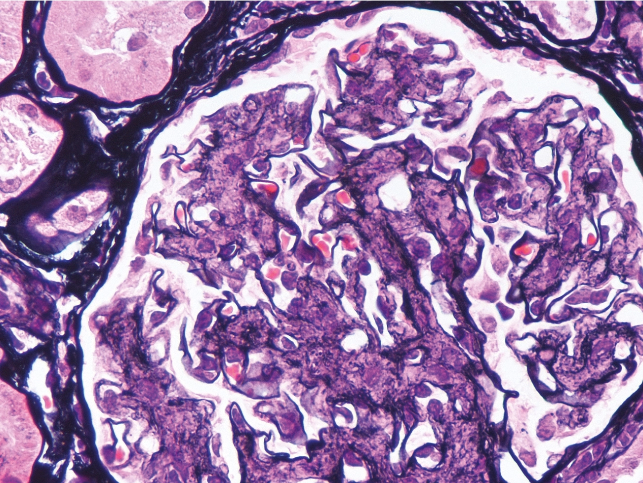 Plata metenamina con pérdida de argirofilia mesangial y aumento de eosinofilia por depósito de fibras en glomerulonefritis fibrilar