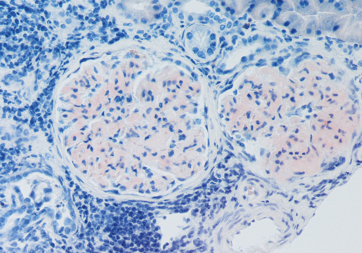 Tinción rojo Congo con leve positividad en glomerulonefritis fibrilar, habitualmente negativa