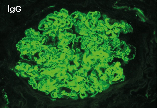 IFD para IgG con patrón borroso en mesangio y paredes capilares y tinción pseudolineal en capilares en glomerulonefritis fibrilar