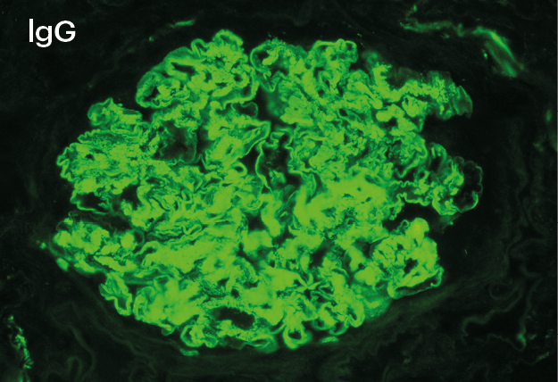 IFD para IgG con patrón borroso en mesangio y paredes capilares y tinción pseudolineal en capilares en glomerulonefritis fibrilar