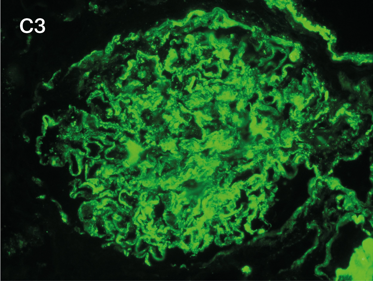 IFD para C3 3+ con patrón borroso en mesangio y paredes capilares en glomerulonefritis fibrilar