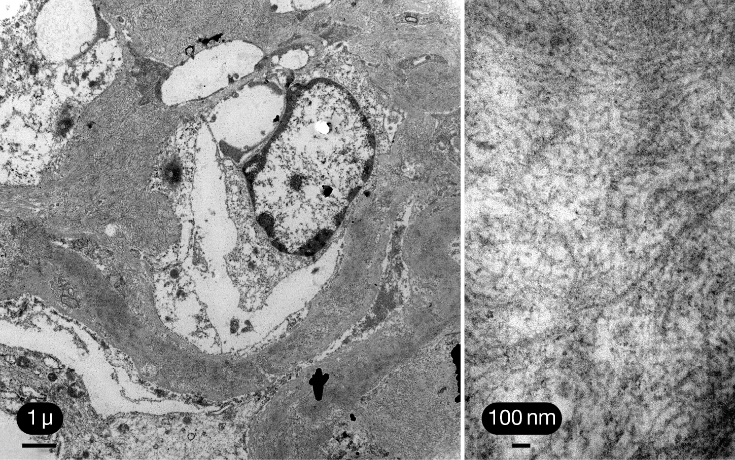 MET con engrosamiento de paredes capilares por depósito de fibras dispuestas al azar en glomerulonefritis fibrilar