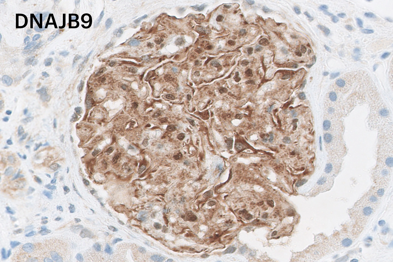 Inmunohistoquímica para DNAJB9 con positividad en paredes capilares y mesangio diagnóstica de glomerulonefritis fibrilar
