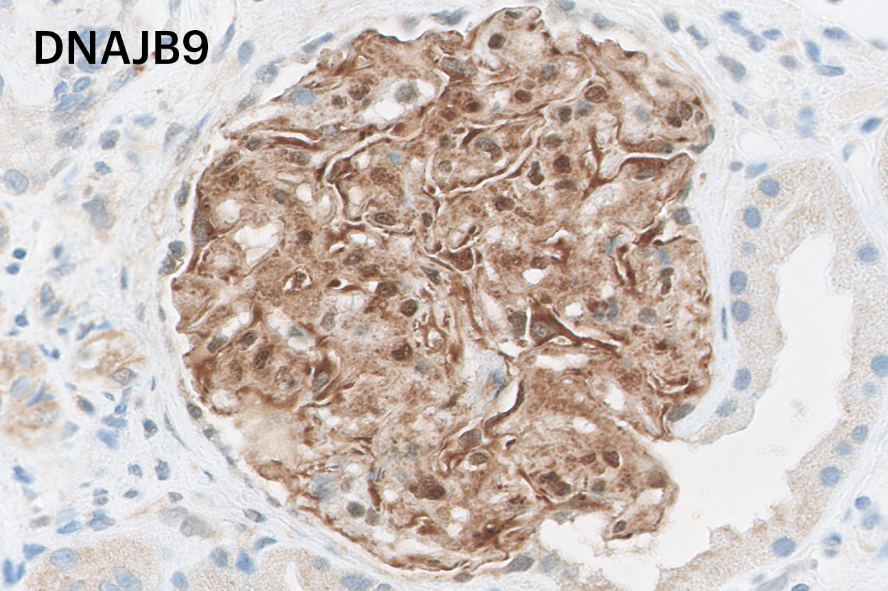 Inmunohistoquímica para DNAJB9 con positividad en paredes capilares y mesangio diagnóstica de glomerulonefritis fibrilar