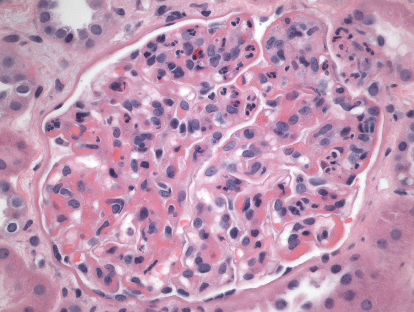 H&E con expansión mesangial, engrosamiento capilar y patrón proliferativo endocapilar con depósitos que imitan asas de alambre en glomerulopatía inmunotactoide