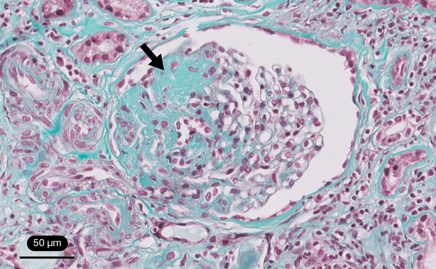 Tricrómico de Masson con lesión esclerosante segmentaria paucicelular entre las 7 y 11 h del ovillo glomerular en GEFS variante NOS