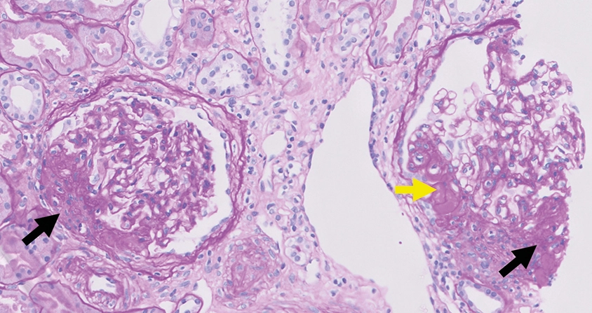 PAS con lesiones esclerosantes perihiliares, signos de isquemia, fibrosis pericapsular e hialinosis en GEFS variante perihiliar con HTA