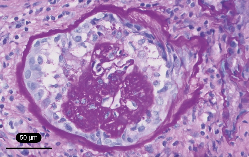 PAS con lesión esclerosante con colapso del ovillo glomerular y proliferación extracapilar de podocitos en GEFS variante colapsante