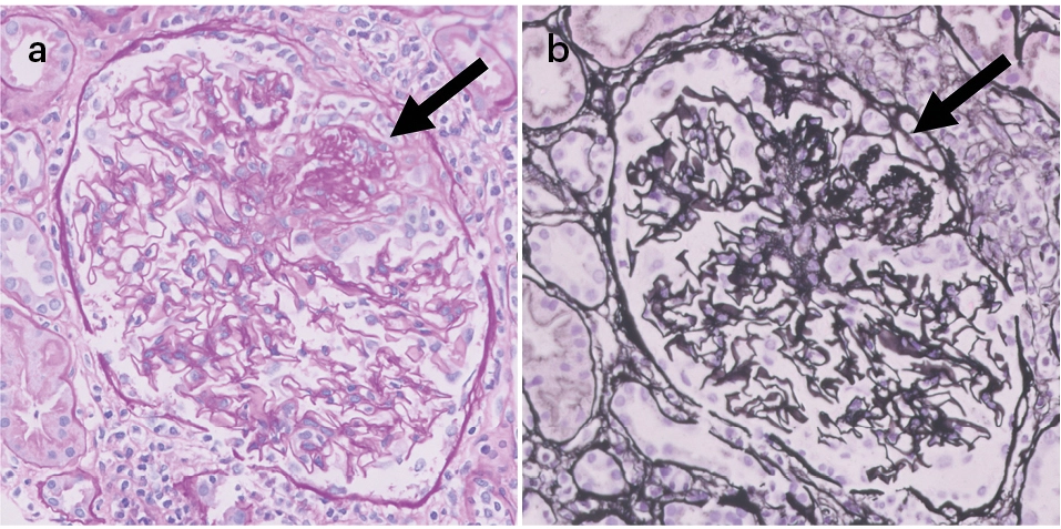 Tinción de PAS. GEFS variante colapsante. Lesión esclerosante con colapso del ovillo glomerular y rodeada por una proliferación extracapilar celular a expensas de podocitos. 40x.