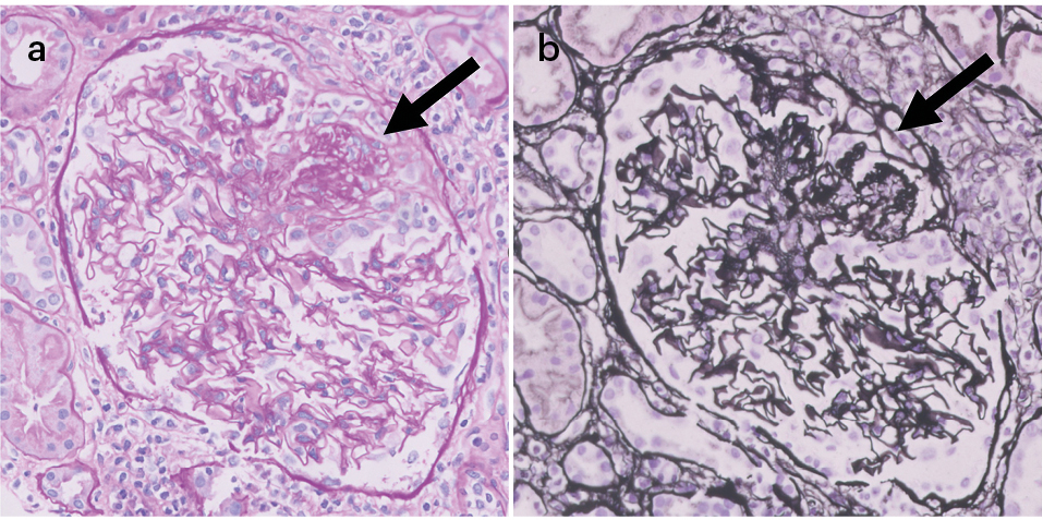 Tinción de PAS. GEFS variante colapsante. Lesión esclerosante con colapso del ovillo glomerular y rodeada por una proliferación extracapilar celular a expensas de podocitos. 40x.
