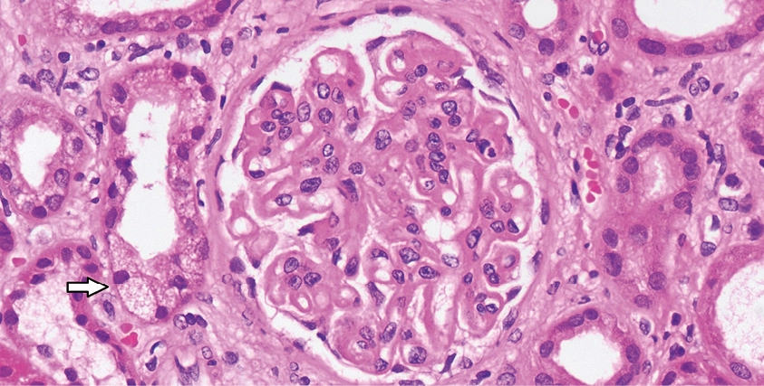 H&E con engrosamiento difuso de paredes capilares glomerulares y vacuolas por reabsorción proteica en nefropatía membranosa