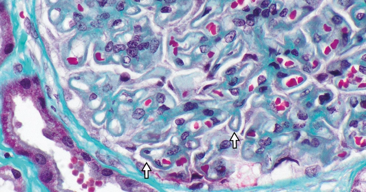 Tricrómico de Masson con depósitos subepiteliales de color rojo en nefropatía membranosa