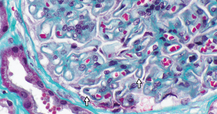 Tricrómico de Masson con depósitos subepiteliales de color rojo en nefropatía membranosa