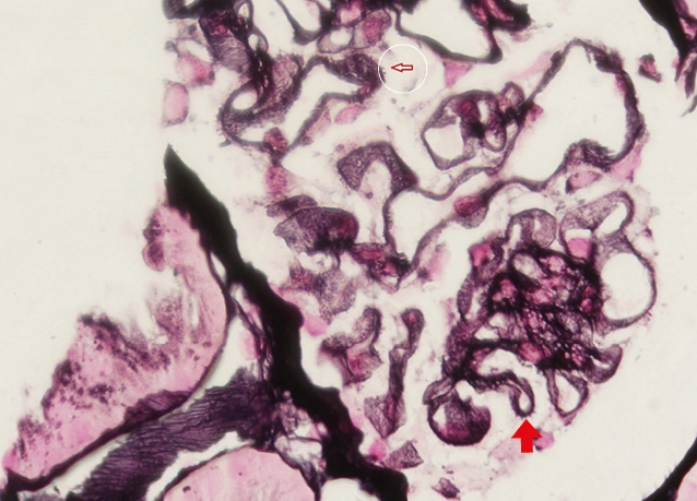 Tinción de plata metenamina con proyecciones perpendiculares en la parte externa de la membrana basal glomerular o spikes en nefropatía membranosa