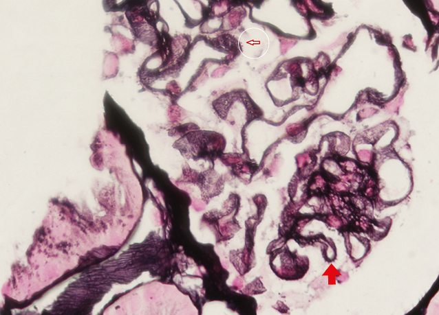 Tinción de plata metenamina con proyecciones perpendiculares en la parte externa de la membrana basal glomerular o spikes en nefropatía membranosa