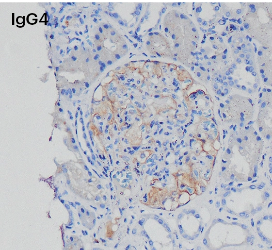 Inmunohistoquímica positiva para IgG4 en capilares glomerulares en nefropatía membranosa