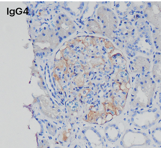 Inmunohistoquímica positiva para IgG4 en capilares glomerulares en nefropatía membranosa