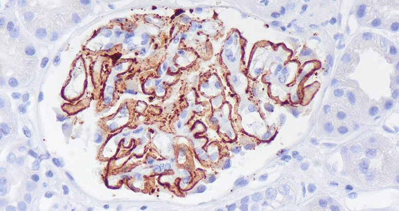 Inmunohistoquímica positiva para PLA2r en capilares glomerulares en nefropatía membranosa primaria