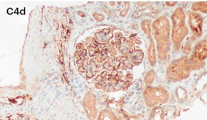 Inmunohistoquímica positiva para C4d con depósitos granulares en capilares glomerulares en nefropatía membranosa