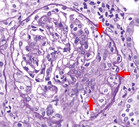PAS con semiluna fibrocelular compuesta en un 50% por células y el resto por matriz fibrosa en glomerulonefritis extracapilar