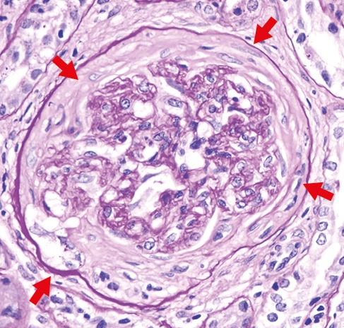 PAS con semiluna fibrosa formada en más del 75% por matriz fibrosa en glomerulonefritis extracapilar