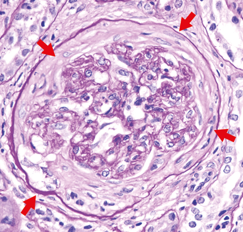 PAS con semiluna fibrosa formada en más del 75% por matriz fibrosa en glomerulonefritis extracapilar