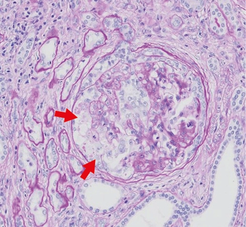 PAS con hiperplasia e hipertrofia de podocitos que colapsan el ovillo glomerular en GEFS colapsante