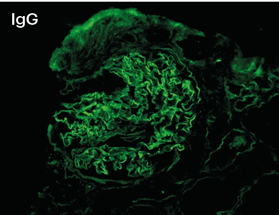 IFD para IgG con depósitos lineales intensos 3+ en membrana basal glomerular en enfermedad anti-MB