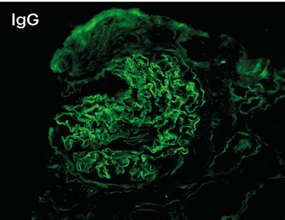IFD para IgG con depósitos lineales intensos 3+ en membrana basal glomerular en enfermedad anti-MB