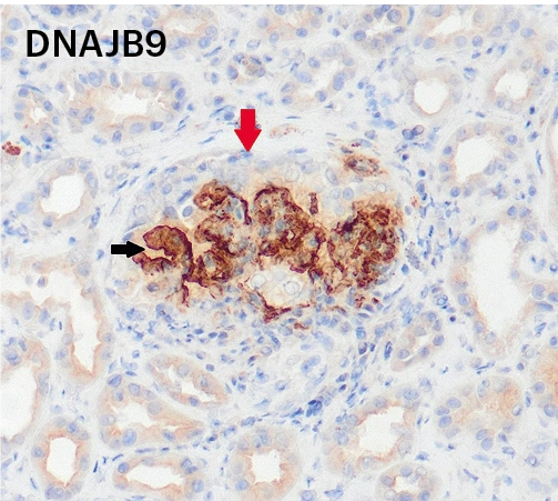 Inmunohistoquímica positiva para DNAJB9 con semiluna celular en paciente con nefropatía fibrilar