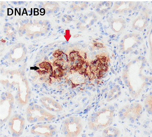 Inmunohistoquímica positiva para DNAJB9 con semiluna celular en paciente con nefropatía fibrilar