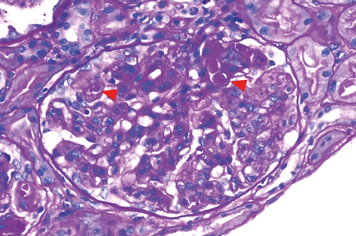 H&E con lesiones proliferativas: glomérulo con hipercelularidad, cariorrexis y neutrófilos en nefritis lúpica