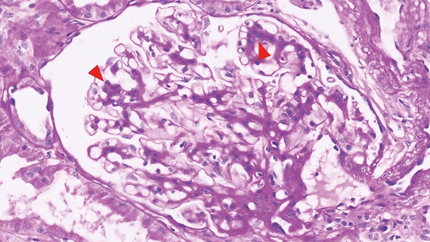 PAS con leve proliferación mesangial en paciente con enfermedad mixta del tejido conectivo