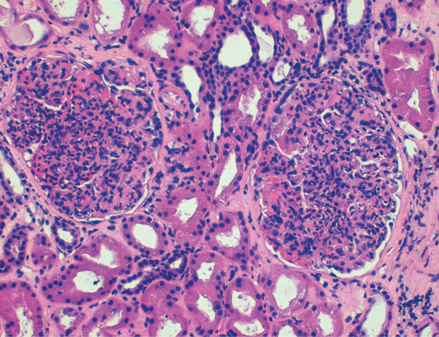 H&E con hipercelularidad mesangial y endocapilar en glomerulonefritis aguda postinfecciosa