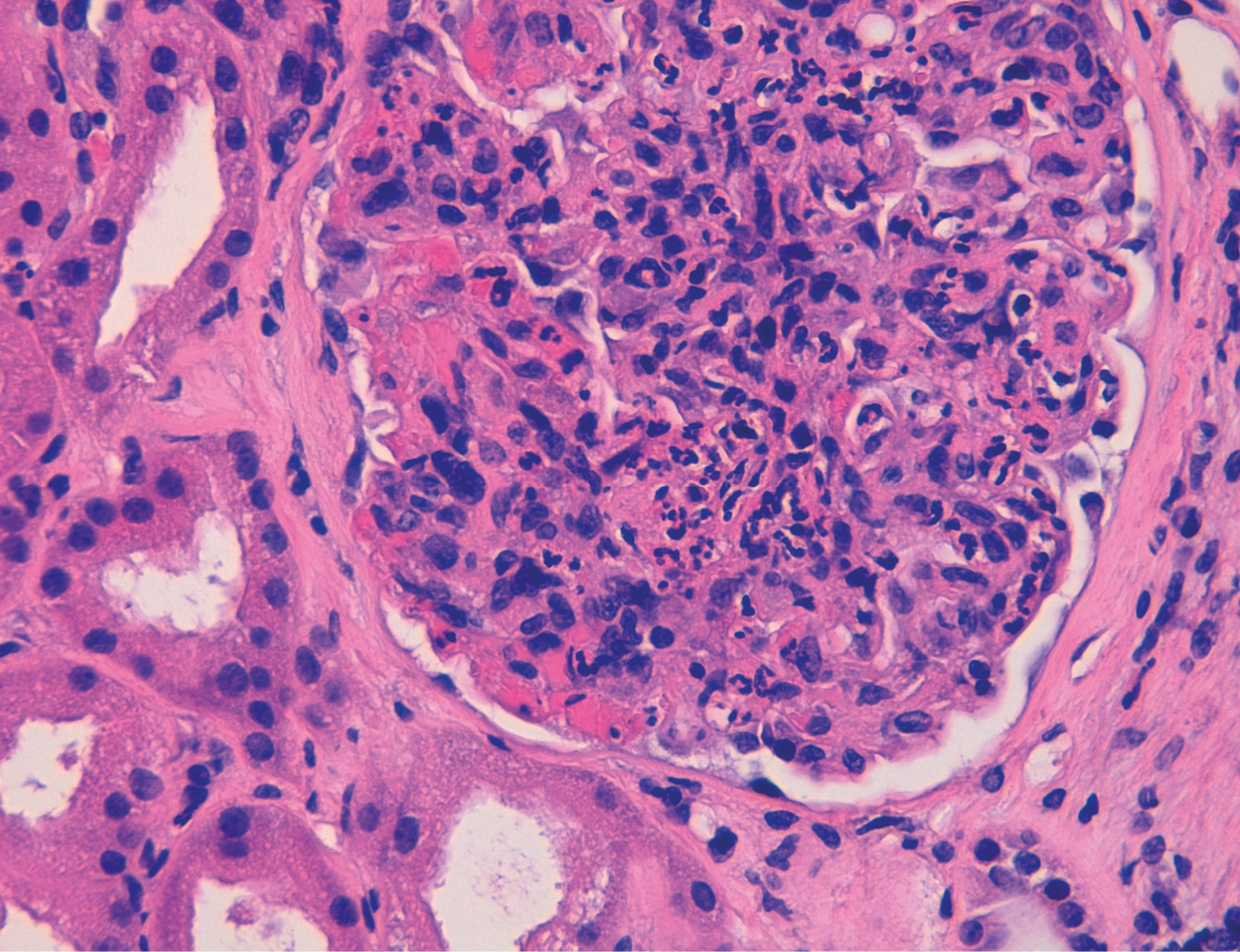 H&E con detalle de hipercelularidad y abundantes polimorfonucleares neutrófilos en glomerulonefritis aguda postinfecciosa