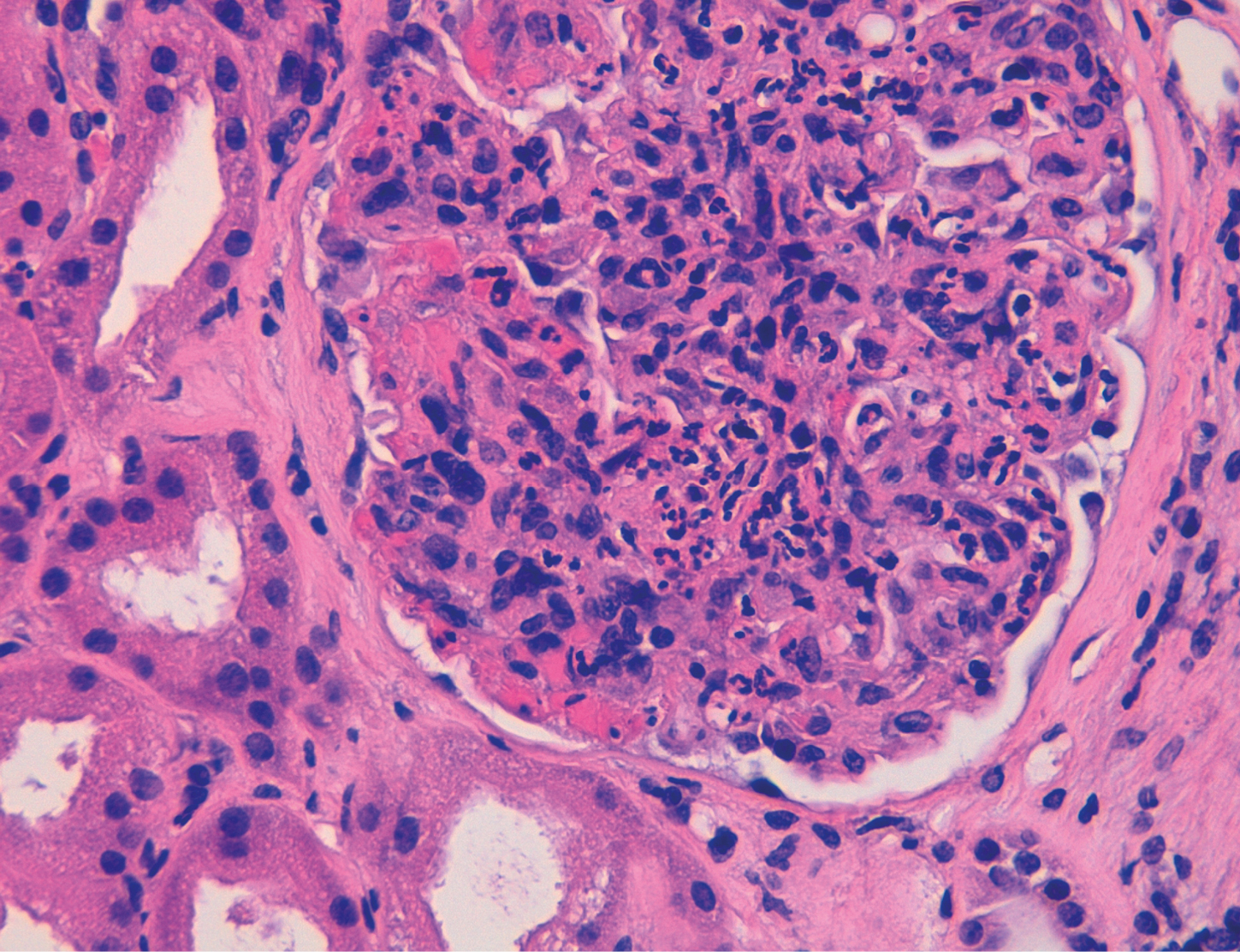 H&E con detalle de hipercelularidad y abundantes polimorfonucleares neutrófilos en glomerulonefritis aguda postinfecciosa