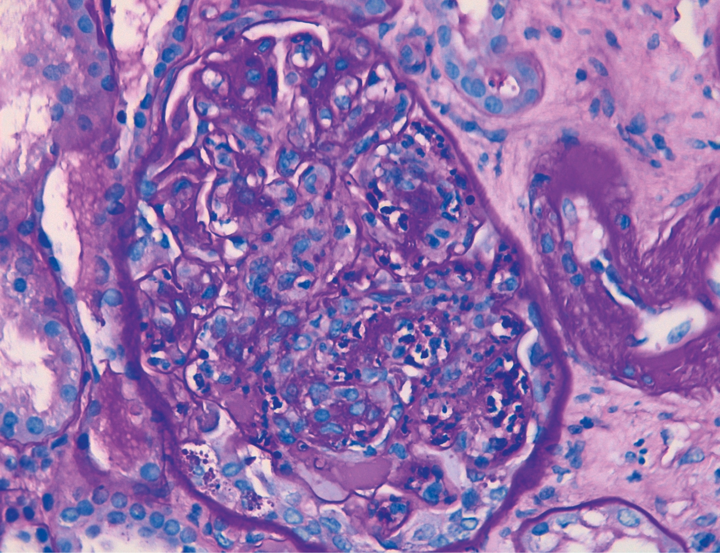 PAS con glomérulo con hipercelularidad de predominio endocapilar en glomerulonefritis aguda postinfecciosa