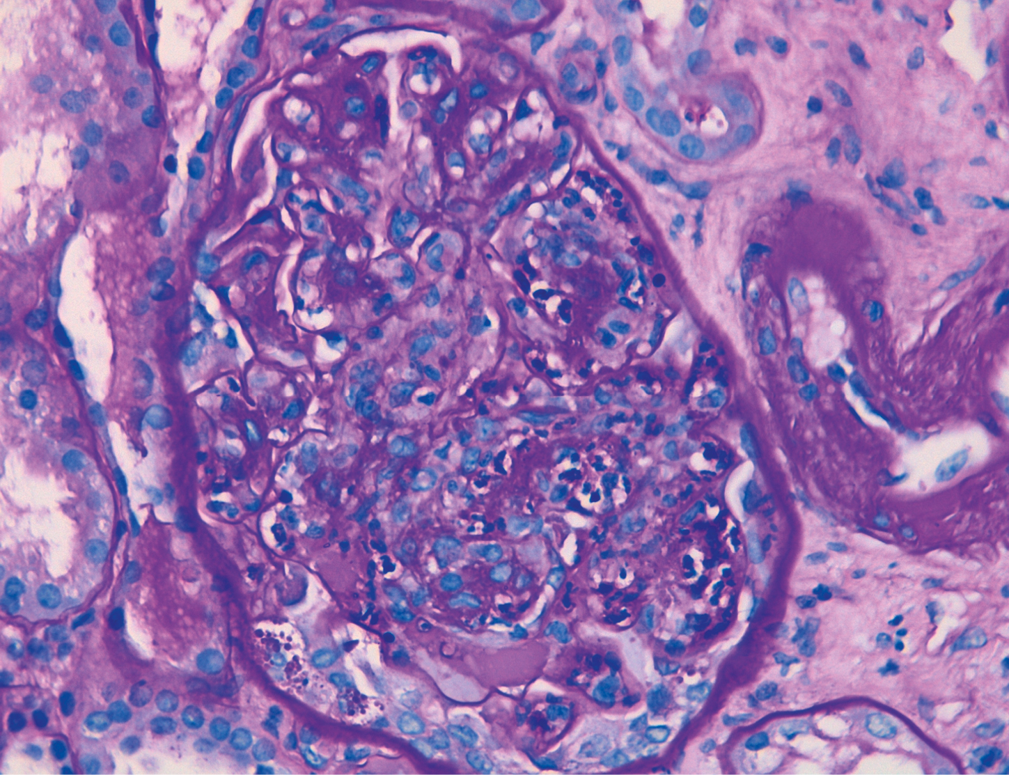 PAS con glomérulo con hipercelularidad de predominio endocapilar en glomerulonefritis aguda postinfecciosa