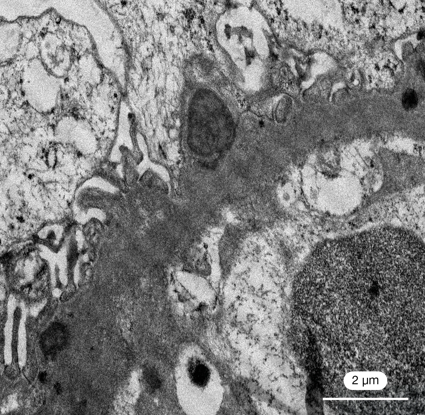 MET con depósitos subepiteliales en joroba en glomerulonefritis aguda postinfecciosa