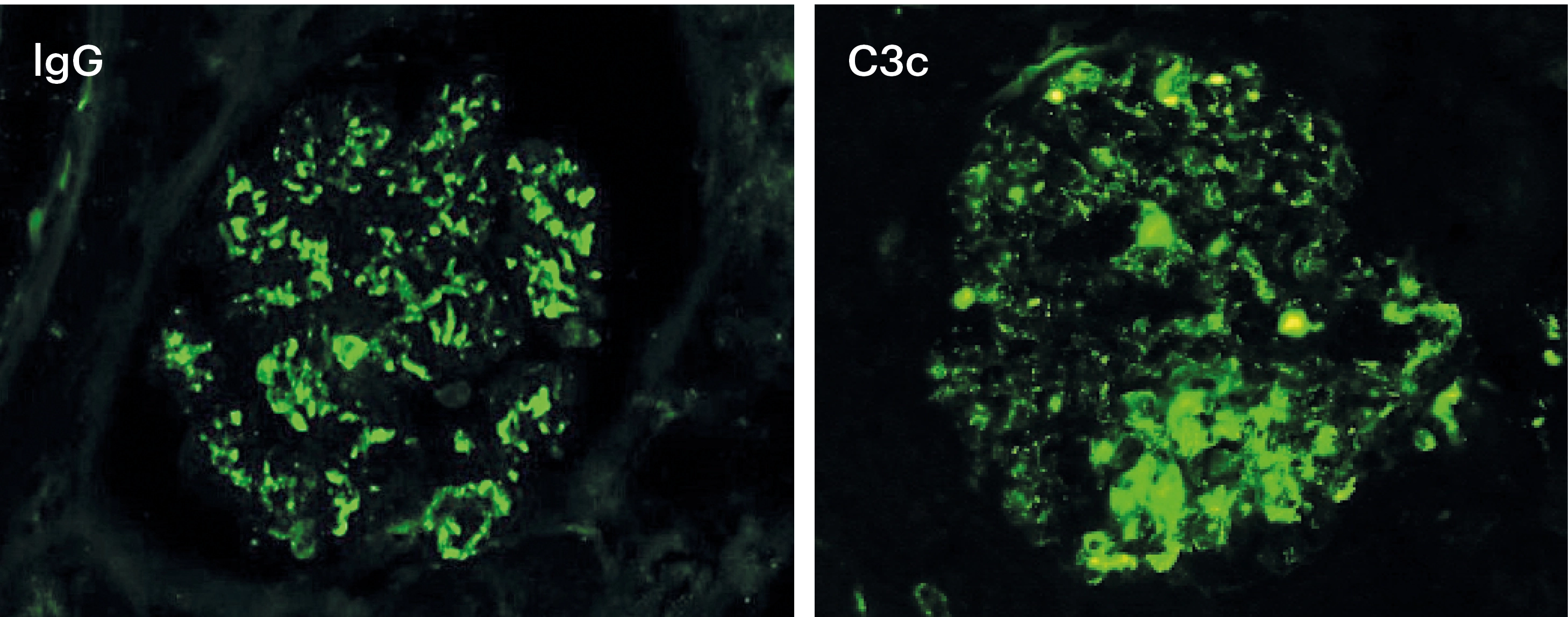 IFD con depósitos granulares dispersos de IgG y C3c de intensidad moderada 2+ en glomerulonefritis aguda postinfecciosa