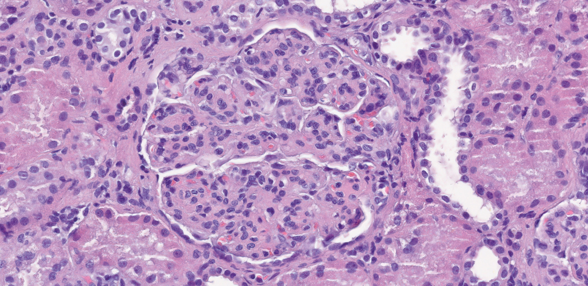 H&E con hipercelularidad mesangial y endocapilar con lobulación en GN postinfecciosa asociada a endocarditis infecciosa