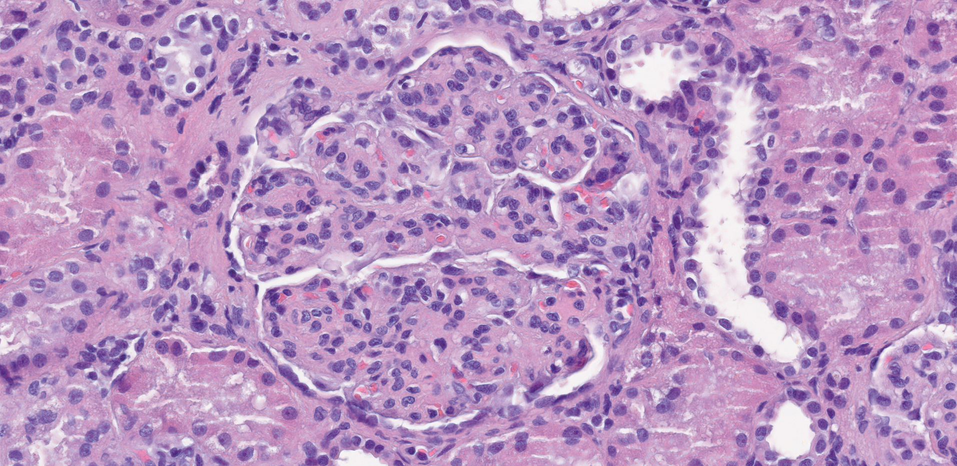 H&E con hipercelularidad mesangial y endocapilar con lobulación en GN postinfecciosa asociada a endocarditis infecciosa