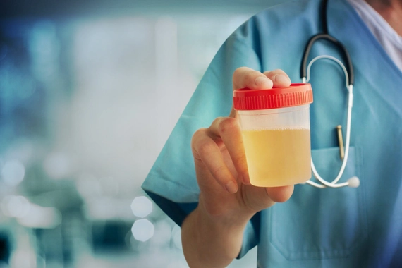 Imagen ilustrativa Orina espumosa