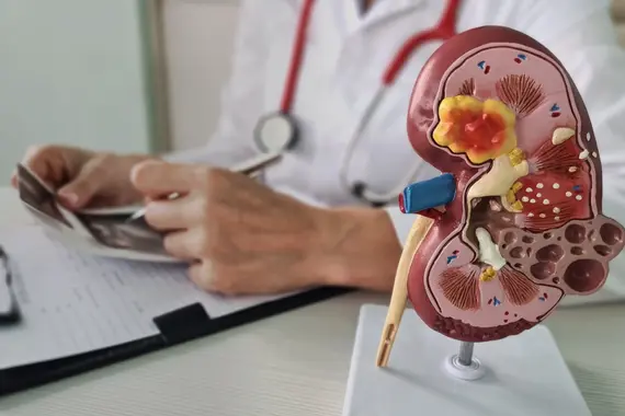 Imagen ilustrativa insuficiencia renal