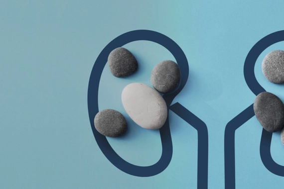 Imagen ilustrativa cálculos renales vs insuficiencia renal