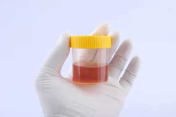 Imagen ilustrativa hematuria sangre en la orina