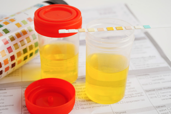 Albuminuria: qué es la albúmina en la orina | Novartis Argentina S.A.